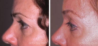 Female eye, before and after brow lift treatment, l-side view, patient 4