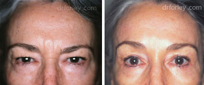 Female eye, before and after brow lift treatment, front view, patient 5