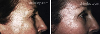 Female eye, before and after brow lift treatment, r-side view, patient 6