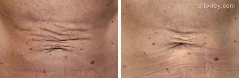 Woman’s abdomen, before and after BodyTite treatment, front view, patient 16