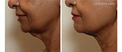 Female face, before and after Facetite treatment, side view, patient 6