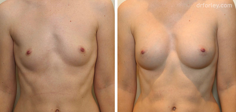 Woman's breasts, Before and After Treatment photo, oblique view, female patient 7