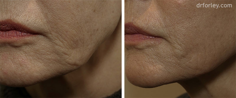 Female face, before and after Evoke treatment, oblique view, patient 8