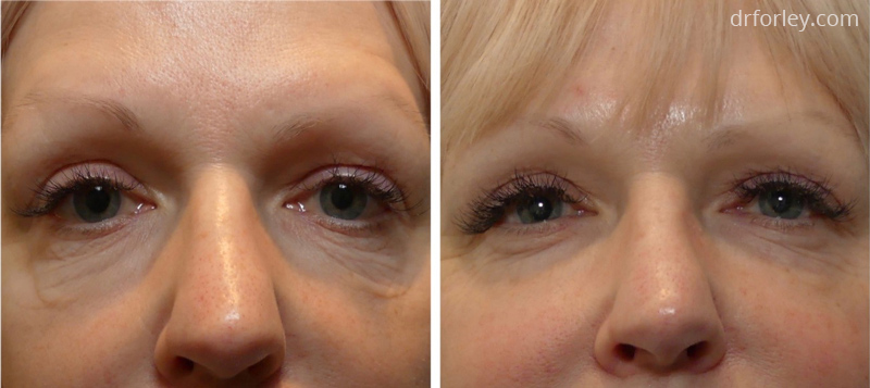 Woman’s face, before and after Morpheus8 and Fractora treatments, front view, patient 6