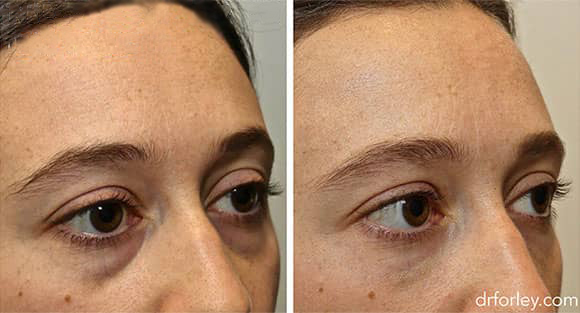 Female face, before and after Injectable Fillers treatment, oblique view, patient 1