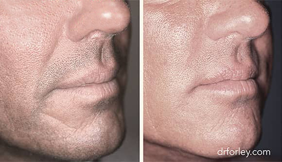 Male face, before and after Injectable Fillers treatment, oblique view, patient 2