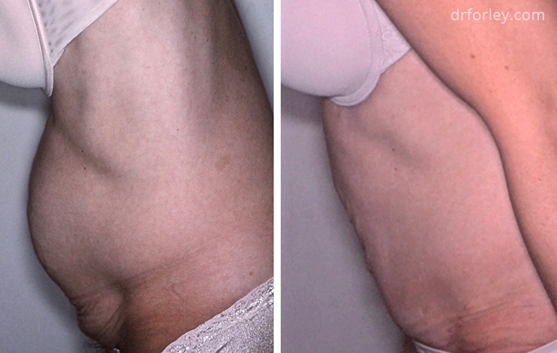 Female body, TUMMY TUCK, Before and After treatment photo, side view, patient 3