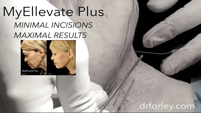 71 year old female discusses her experience with MyEllevate Plus