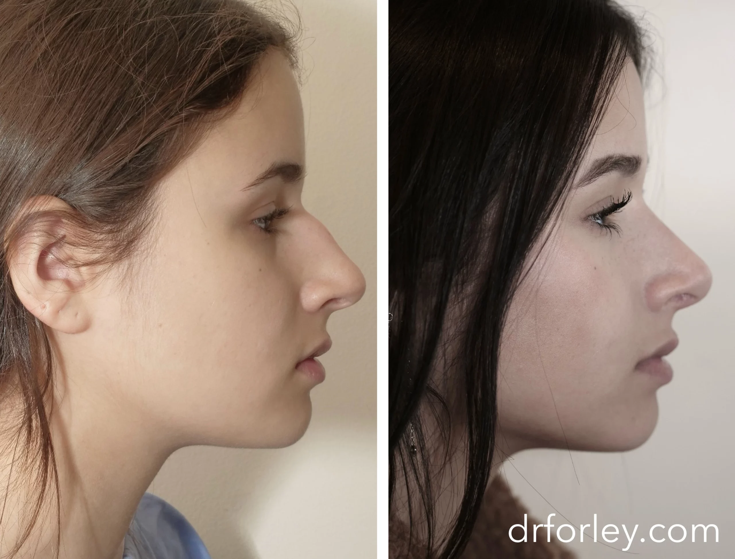 Woman's face, before and after Nose Surgery Treatment, female nose, patient 1